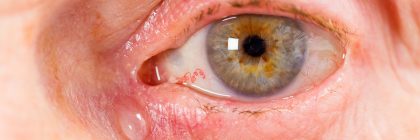 retinopatia-diabetica