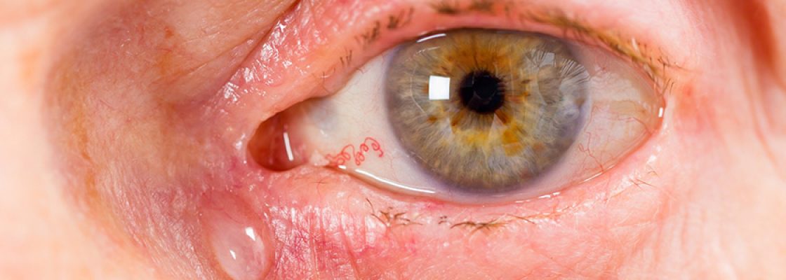 retinopatia-diabetica