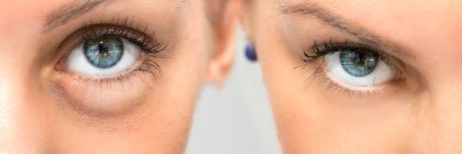 Rejuvenescimento Periocular