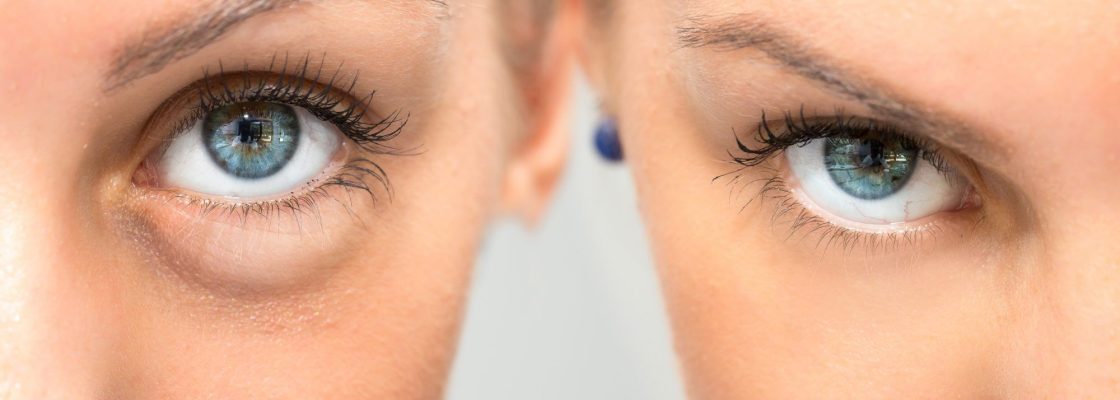 Rejuvenescimento Periocular